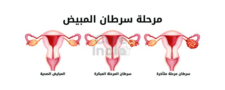 سرطان المبيض